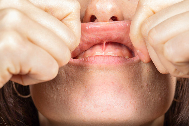 Close up of a doctor lifting up someones upper lip to reveal a patients gums