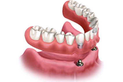Illustration of snap in dentures