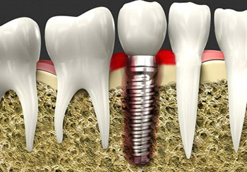 An illustration showing swollen gums around an implant