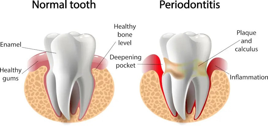 Illustration showing the difference between a normal tooth and one with periodontitis